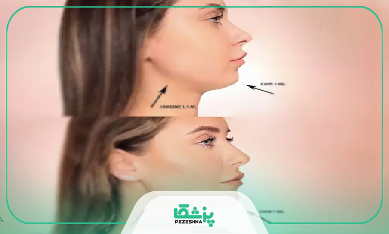 چه کسانی نمیتوانند ساکشن غبغب انجام دهند؟