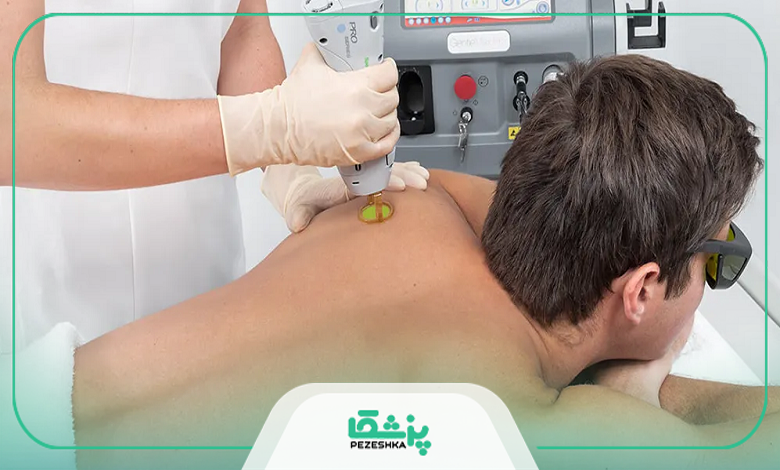لیزر فول بادی یا اپیلاسیون؛ کدام بهتر است؟