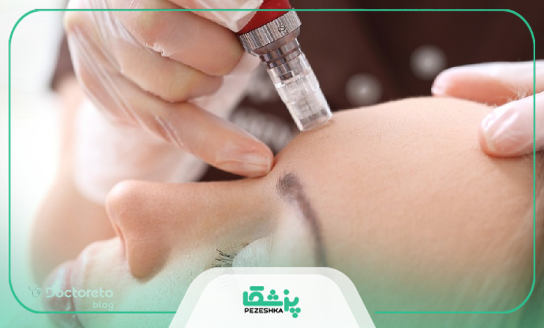 مزوتراپی با میکرونیدلینگ چه فرقی دارد؟