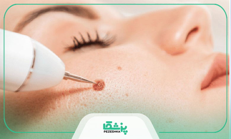 چگونه از بروز خال در صورت پیشگیری کنیم؟