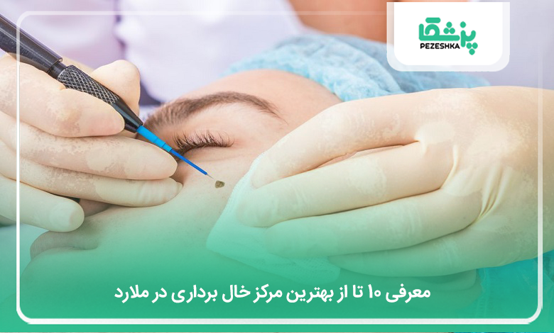 بهترین مرکز خال برداری در ملارد
