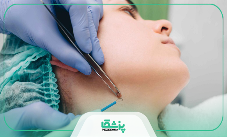 خال برداری برای چه افرادی ممنوع است؟