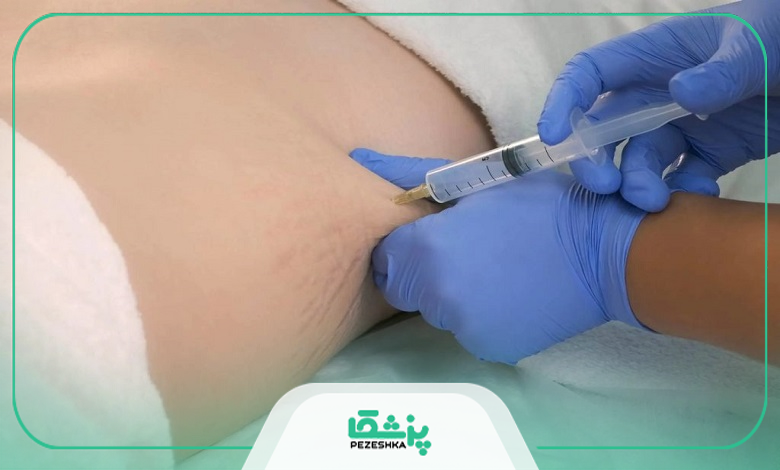 ماندگاری تزریق چربی و عوامل مؤثر بر دوام نتایج