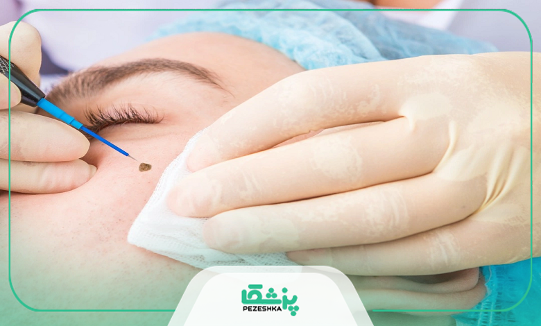 آیا خالبرداری خطرناک است؟ مهمترین عوارضی که باید بدانید