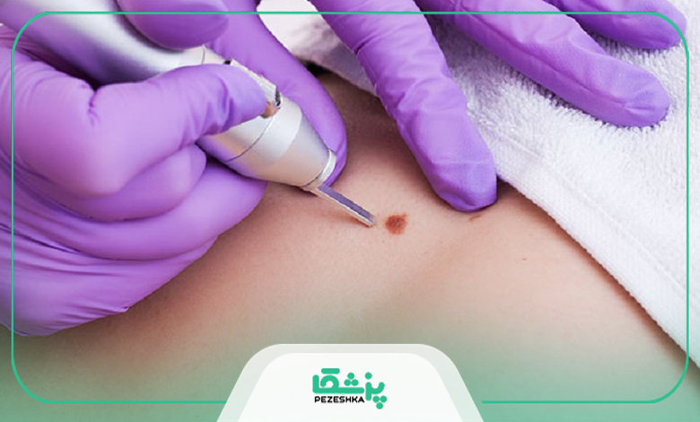 عوارض احتمالی خال برداری