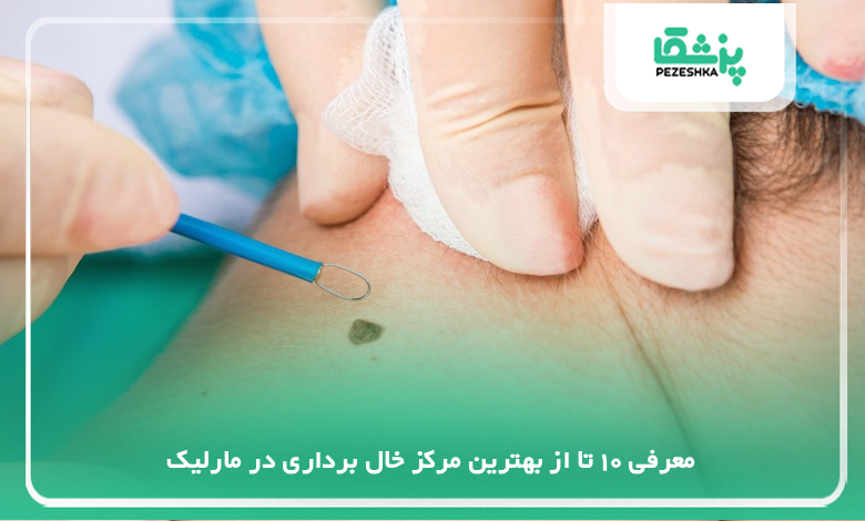 بهترین مرکز خال برداری در مارلیک