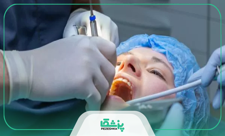 مراقبتهای بعد از جراحی دندان عقل نهفته