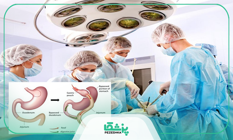 عوارض عمل بای پس معده