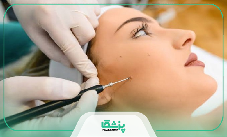 عوارض احتمالی برداشتن خال صورت