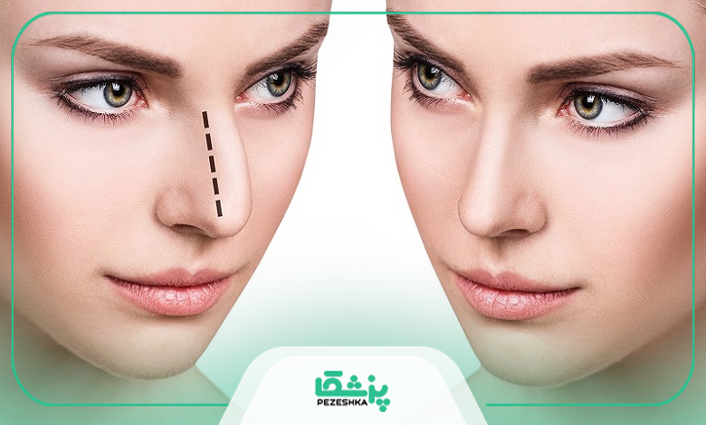 چه کسانی کاندیدای جراحی بینی استخوانی هستند؟